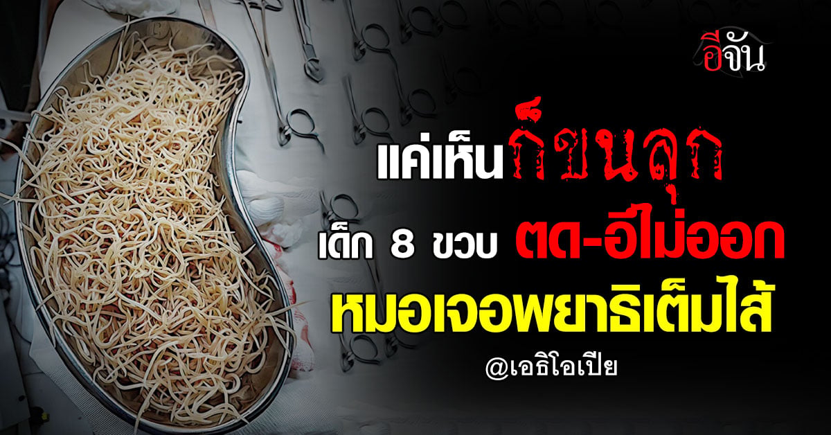 สยอง ! เด็ก 8 ขวบ อึ-ตดไม่ออก สุดท้ายพบพยาธิไส้เดือนเต็มลำไส้ ต้องผ่าตัดด่วน
