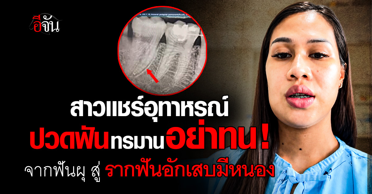 ปวดฟันทรมาน อย่าทน! สาวแชร์อุทาหรณ์ จากฟันผุ สู่รากฟันอักเสบ